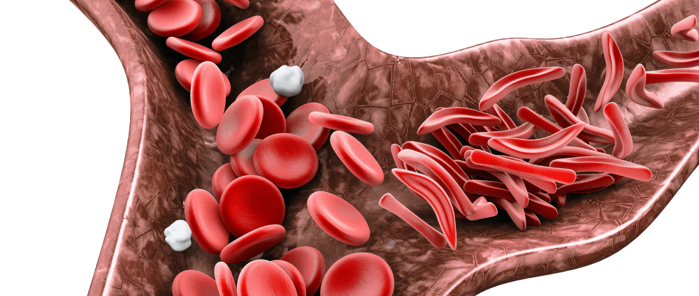 Complications of Sickle Cell Anemia