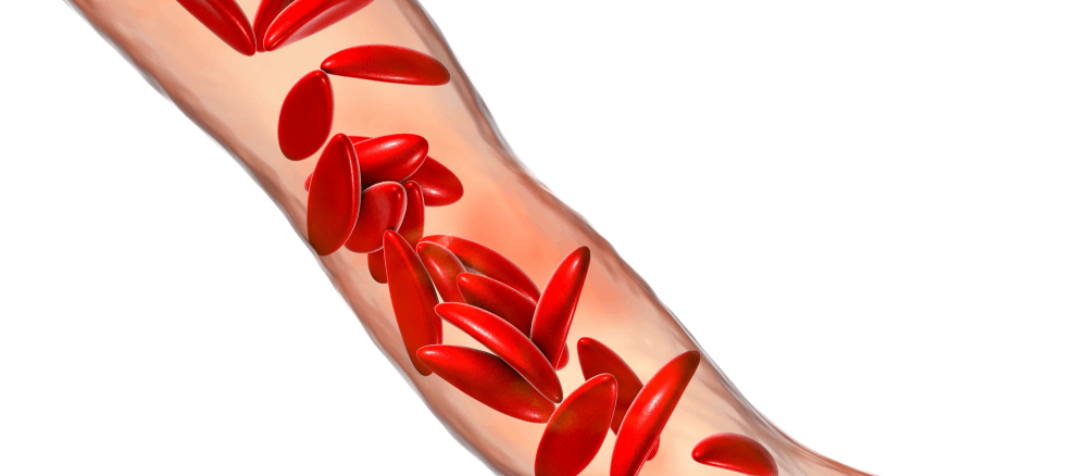 Facts About Sickle Cell Anemia